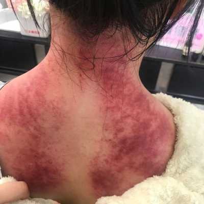 孕妇可以肩颈刮痧吗?怀孕两个多月了,孕期可以面部刮痧吗 第2张 孕妇可以肩颈刮痧吗?怀孕两个多月了,孕期可以面部刮痧吗 第2张
