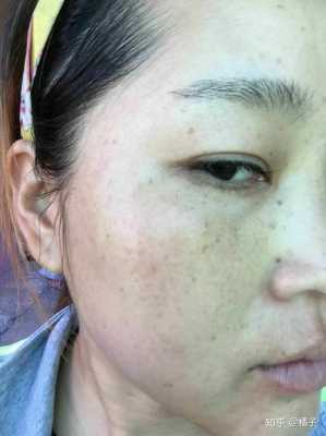 孕期妊辰斑（孕期妊辰斑怎么去掉）  第2张