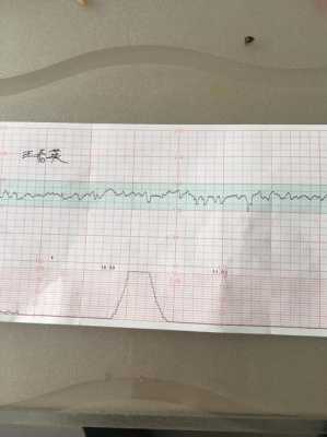胎心监护一般多少周可以做,孕期胎心监护总不过关,为啥? 第2张 胎心监护一般多少周可以做,孕期胎心监护总不过关,为啥? 第2张