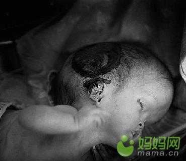 辐射会导致胎儿畸形吗（手机辐射会导致胎儿畸形吗）  第1张