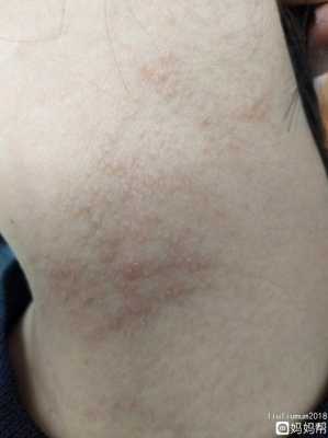 孕期为什么出湿疹（孕妇身上起疹子怎么回事）  第2张