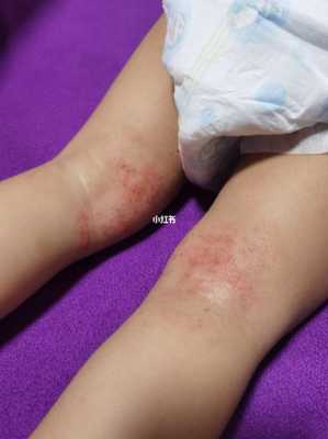 孕妇出湿疹怎么办,吃什么缓解孕期湿疹最有效 第2张 孕妇出湿疹怎么办,吃什么缓解孕期湿疹最有效 第2张