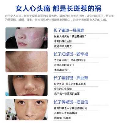 妊娠斑如何治疗,孕期长黄褐斑什么原因 第1张 妊娠斑如何治疗,孕期长黄褐斑什么原因 第1张