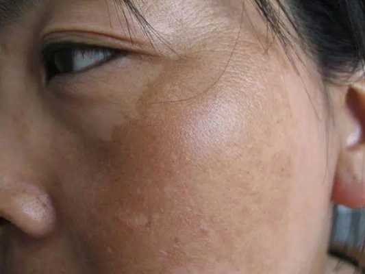 妊娠斑如何治疗,孕期长黄褐斑什么原因 第2张 妊娠斑如何治疗,孕期长黄褐斑什么原因 第2张
