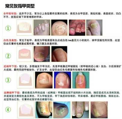 孕妇灰指甲对胎儿有影响吗(孕妇灰指甲对胎儿有影响吗图片) 第1张 孕妇灰指甲对胎儿有影响吗(孕妇灰指甲对胎儿有影响吗图片) 第1张