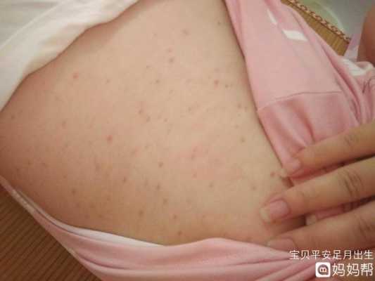 孕期身上起红疙瘩(孕期身上起红疙瘩很痒是怎么回事) 第2张 孕期身上起红疙瘩(孕期身上起红疙瘩很痒是怎么回事) 第2张