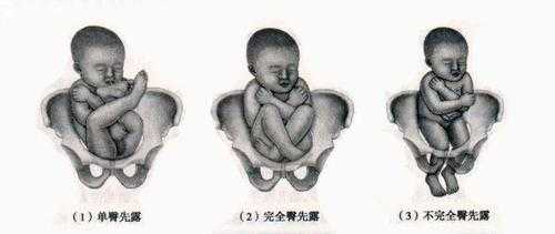 怀孕八个月女胎儿图(怀孕八个月臀位胎儿还会下降吗) 第3张 怀孕八个月女胎儿图(怀孕八个月臀位胎儿还会下降吗) 第3张