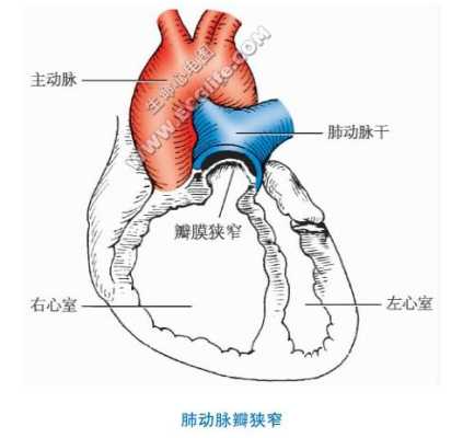 六个月胎儿肺动脉狭窄(什么是先天性肺动脉瓣狭窄) 第2张 六个月胎儿肺动脉狭窄(什么是先天性肺动脉瓣狭窄) 第2张