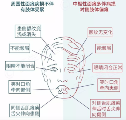胎儿面瘫(面瘫对怀孕有影响吗) 第1张 胎儿面瘫(面瘫对怀孕有影响吗) 第1张