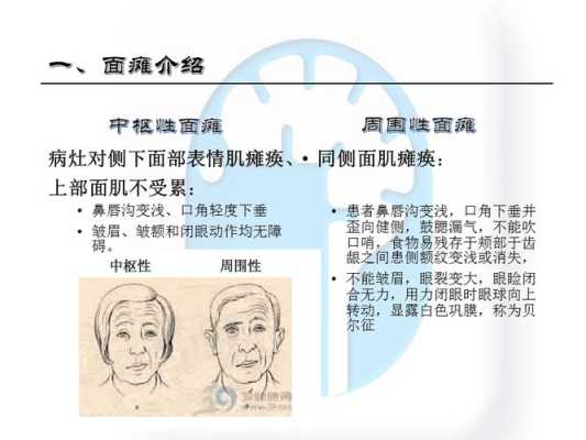 胎儿面瘫(面瘫对怀孕有影响吗) 第2张 胎儿面瘫(面瘫对怀孕有影响吗) 第2张