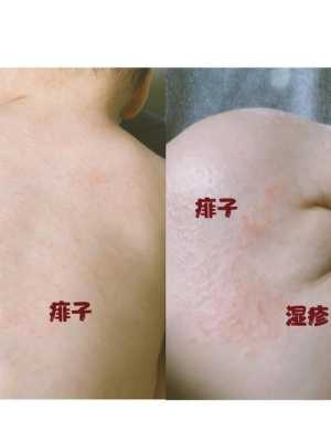 孕期长湿疹影响胎儿吗(孕妇在怀孕期间起湿疹对胎儿有影响吗) 第1张 孕期长湿疹影响胎儿吗(孕妇在怀孕期间起湿疹对胎儿有影响吗) 第1张