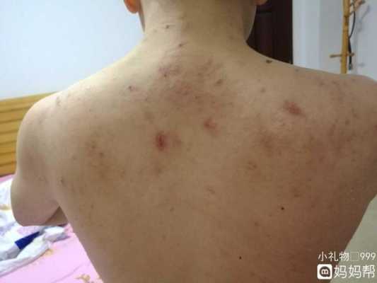 孕期长湿疹影响胎儿吗(孕妇在怀孕期间起湿疹对胎儿有影响吗) 第3张 孕期长湿疹影响胎儿吗(孕妇在怀孕期间起湿疹对胎儿有影响吗) 第3张