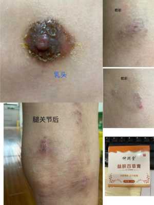 乳头湿疹怎么治疗,孕期乳晕湿疹是什么原因 第2张 乳头湿疹怎么治疗,孕期乳晕湿疹是什么原因 第2张
