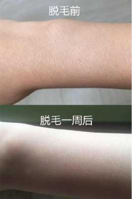 怀孕了做了脱毛怎么办,怀孕期间激光脱毛有影响吗 第1张 怀孕了做了脱毛怎么办,怀孕期间激光脱毛有影响吗 第1张