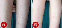 怀孕了做了脱毛怎么办,怀孕期间激光脱毛有影响吗 第2张 怀孕了做了脱毛怎么办,怀孕期间激光脱毛有影响吗 第2张