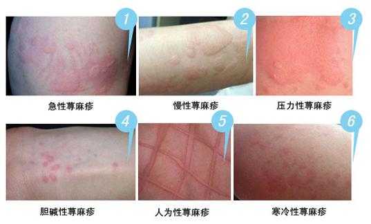 怀孕了得荨麻疹怎么办,孕期荨麻疹症状图片大全 第2张 怀孕了得荨麻疹怎么办,孕期荨麻疹症状图片大全 第2张