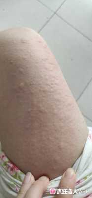 怀孕了得荨麻疹怎么办,孕期荨麻疹症状图片大全 第3张 怀孕了得荨麻疹怎么办,孕期荨麻疹症状图片大全 第3张