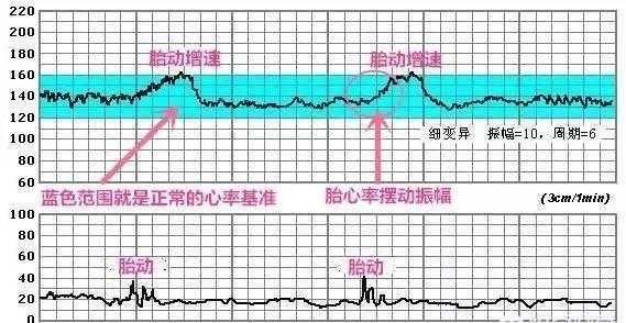 胎儿心率不齐是怎么引起的怎么办,胎儿心率不稳定忽高忽低 第2张 胎儿心率不齐是怎么引起的怎么办,胎儿心率不稳定忽高忽低 第2张