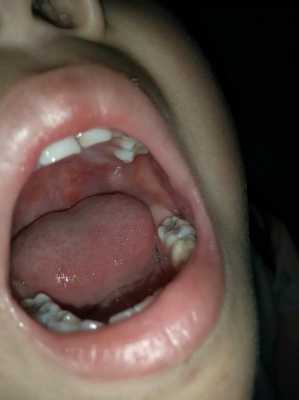 胎儿嘴唇裂(婴儿嘴巴热怎么办呢?是发烧的症状吗) 第3张 胎儿嘴唇裂(婴儿嘴巴热怎么办呢?是发烧的症状吗) 第3张