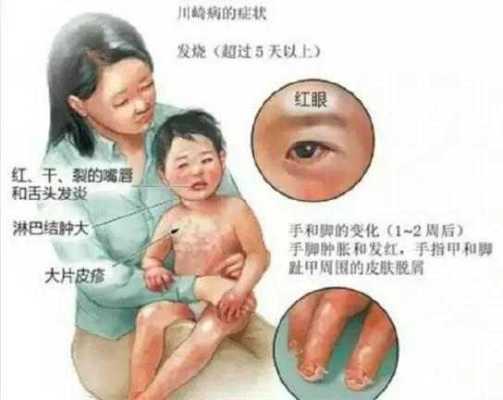胎儿嘴唇裂(婴儿嘴巴热怎么办呢?是发烧的症状吗) 第1张 胎儿嘴唇裂(婴儿嘴巴热怎么办呢?是发烧的症状吗) 第1张