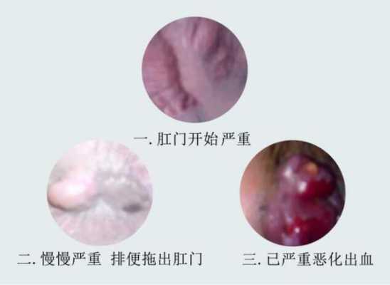 怀孕痔疮流血怎么办,怀孕期间肛门出血对胎儿有影响吗 第1张 怀孕痔疮流血怎么办,怀孕期间肛门出血对胎儿有影响吗 第1张