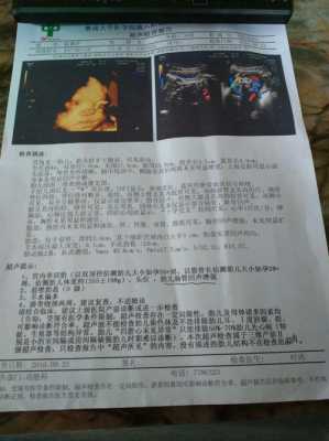 胎儿肠管畸形(26周胎儿局部肠管回声稍增强是怎么回事) 第2张 胎儿肠管畸形(26周胎儿局部肠管回声稍增强是怎么回事) 第2张