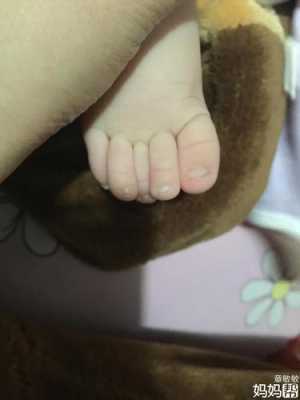 胎儿脚趾畸形(胎儿脚趾畸形) 第2张 胎儿脚趾畸形(胎儿脚趾畸形) 第2张