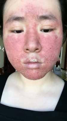孕期激素皮炎怎么办(激素性皮炎怎么治) 第3张 孕期激素皮炎怎么办(激素性皮炎怎么治) 第3张