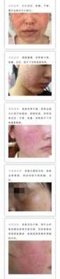 孕期激素皮炎怎么办(激素性皮炎怎么治) 第1张 孕期激素皮炎怎么办(激素性皮炎怎么治) 第1张