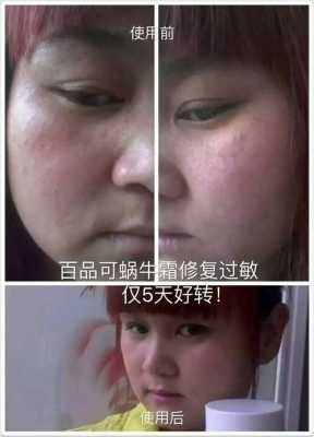 孕妇长湿疹怎么办,孕期脸部湿疹怎么办啊 第1张 孕妇长湿疹怎么办,孕期脸部湿疹怎么办啊 第1张