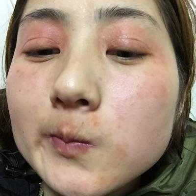 孕妇长湿疹怎么办,孕期脸部湿疹怎么办啊 第2张 孕妇长湿疹怎么办,孕期脸部湿疹怎么办啊 第2张
