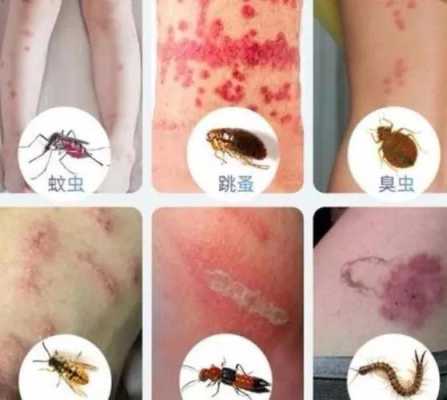 孕期丘疹性荨麻疹(丘疹型荨麻疹该怎样治疗) 第2张 孕期丘疹性荨麻疹(丘疹型荨麻疹该怎样治疗) 第2张