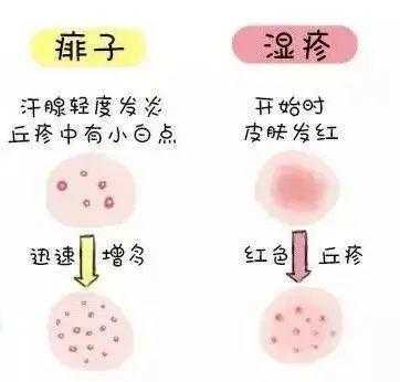 孕期湿疹该怎么办(妊娠痒疹和湿疹的区别图片) 第1张 孕期湿疹该怎么办(妊娠痒疹和湿疹的区别图片) 第1张