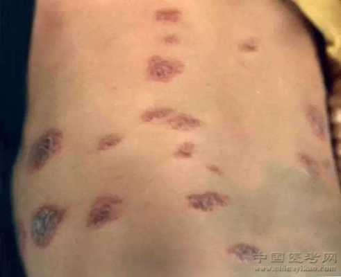 屁股湿疹是怎么回事,为什么孕期屁股长湿疹呢 第2张 屁股湿疹是怎么回事,为什么孕期屁股长湿疹呢 第2张