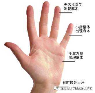 孕晚期右手指尖麻,正常吗?以前都是晚上睡觉时会麻,怀孕期间右手麻木是什么原因 第1张 孕晚期右手指尖麻,正常吗?以前都是晚上睡觉时会麻,怀孕期间右手麻木是什么原因 第1张