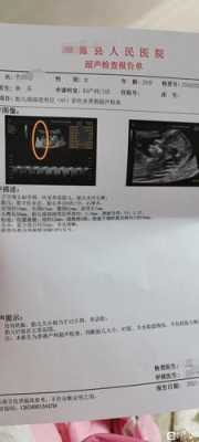 孕期做nt的最佳时间(做nt的周数怎么算) 第2张 孕期做nt的最佳时间(做nt的周数怎么算) 第2张