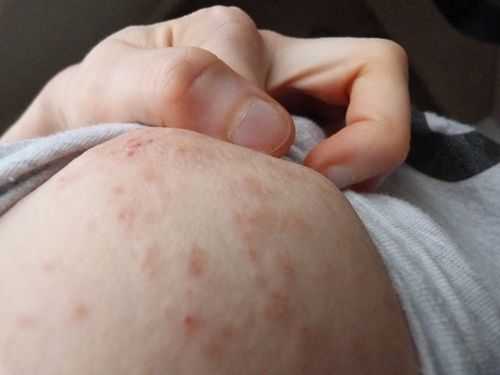 孕期乳房湿疹怎么治疗(乳房湿疹结痂破皮该怎么办) 第2张 孕期乳房湿疹怎么治疗(乳房湿疹结痂破皮该怎么办) 第2张