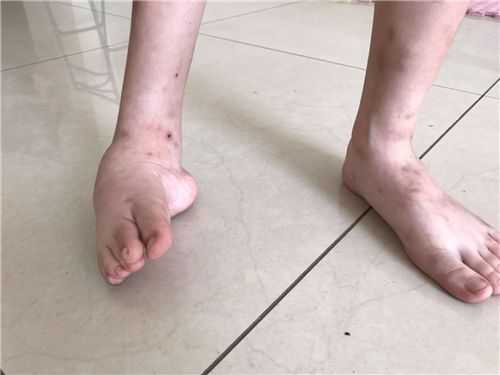 胎儿右脚内翻(新生儿轻微脚内翻是怎么回事呢) 第3张 胎儿右脚内翻(新生儿轻微脚内翻是怎么回事呢) 第3张