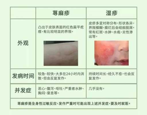 孕期过敏性荨麻疹(孕期过敏性荨麻疹怎么办) 第2张 孕期过敏性荨麻疹(孕期过敏性荨麻疹怎么办) 第2张