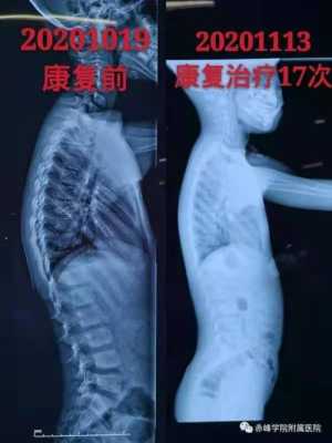 胎儿脊椎侧弯(胎儿脊椎侧弯) 第1张 胎儿脊椎侧弯(胎儿脊椎侧弯) 第1张