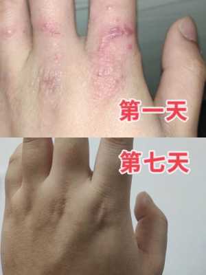 备孕期间湿疹怎么办(备孕期间湿疹怎么办啊) 第1张 备孕期间湿疹怎么办(备孕期间湿疹怎么办啊) 第1张
