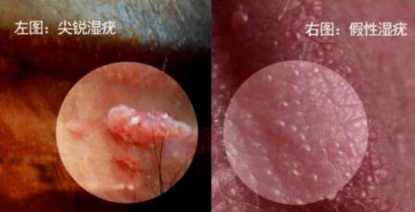 怀孕期间外阴长了疙瘩(孕晚期阴部长了一堆像水泡的疙瘩,怎么回事) 第2张 怀孕期间外阴长了疙瘩(孕晚期阴部长了一堆像水泡的疙瘩,怎么回事) 第2张