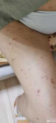 孕期湿疹是什么原因造成(孕期湿疹是什么原因造成的) 第2张 孕期湿疹是什么原因造成(孕期湿疹是什么原因造成的) 第2张