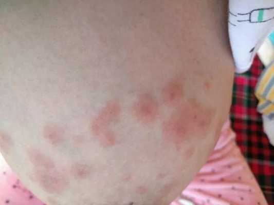 孕期湿疹产后怎么办啊(孕期湿疹产后怎么办啊) 第2张 孕期湿疹产后怎么办啊(孕期湿疹产后怎么办啊) 第2张