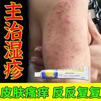 孕期严重湿疹怎么办啊(孕妇得湿疹怎么止痒呢?可以用什么药更快呢) 第2张 孕期严重湿疹怎么办啊(孕妇得湿疹怎么止痒呢?可以用什么药更快呢) 第2张