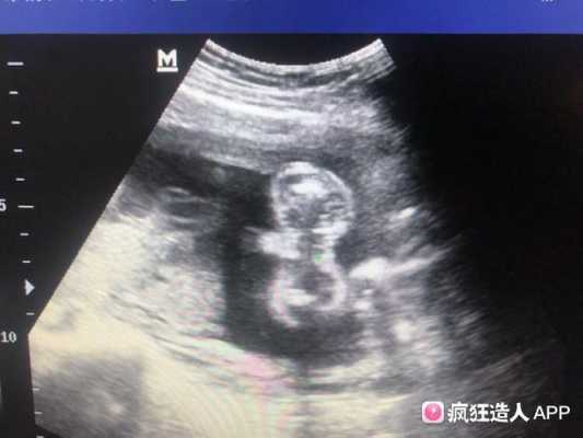 胎儿三线征（胎儿三线征有可能男孩）  第3张