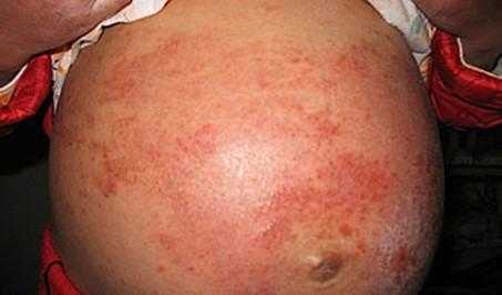 孕期湿疹是怎么回事啊(怀孕湿疹是怎么引起的吗?孕妇湿疹可以用什么药吗) 第2张 孕期湿疹是怎么回事啊(怀孕湿疹是怎么引起的吗?孕妇湿疹可以用什么药吗) 第2张