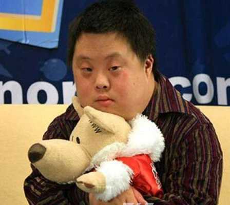 唐氏胎儿的症状(唐氏儿胎儿时的症状) 第2张 唐氏胎儿的症状(唐氏儿胎儿时的症状) 第2张