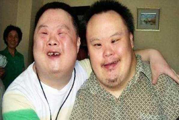唐氏胎儿的症状(唐氏儿胎儿时的症状) 第1张 唐氏胎儿的症状(唐氏儿胎儿时的症状) 第1张