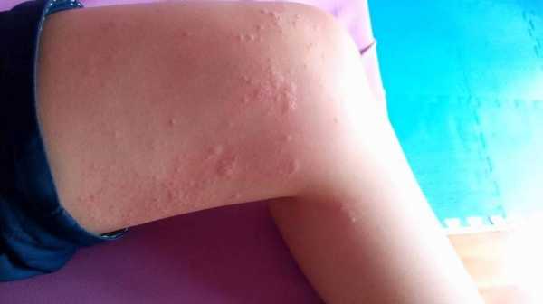 孕期得荨麻疹怎么办(孕妇反复得荨麻疹要怎么治疗) 第2张 孕期得荨麻疹怎么办(孕妇反复得荨麻疹要怎么治疗) 第2张